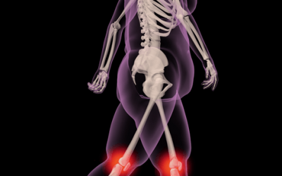 Target Gut Microbiome for Osteoarthritis and Joint Pain